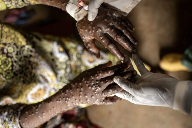 Beždžionių raupai: dėl ko jaudintis, o dėl ko – ne